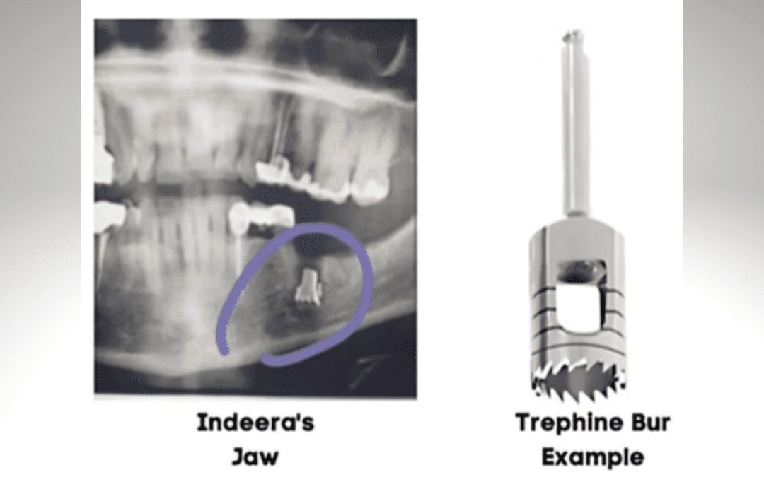 Local Oral Surgeon Sued for Leaving Drill Bit Inside Patient’s Jaw