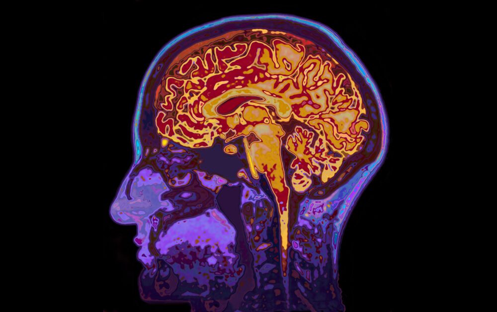 A Single Brain Scan Could Diagnose Alzheimer’s