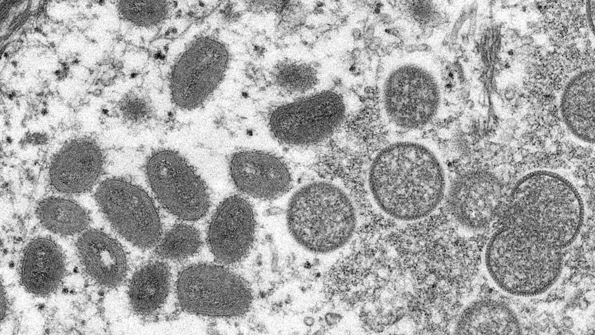 Two Monkeypox Cases Confirmed in Children