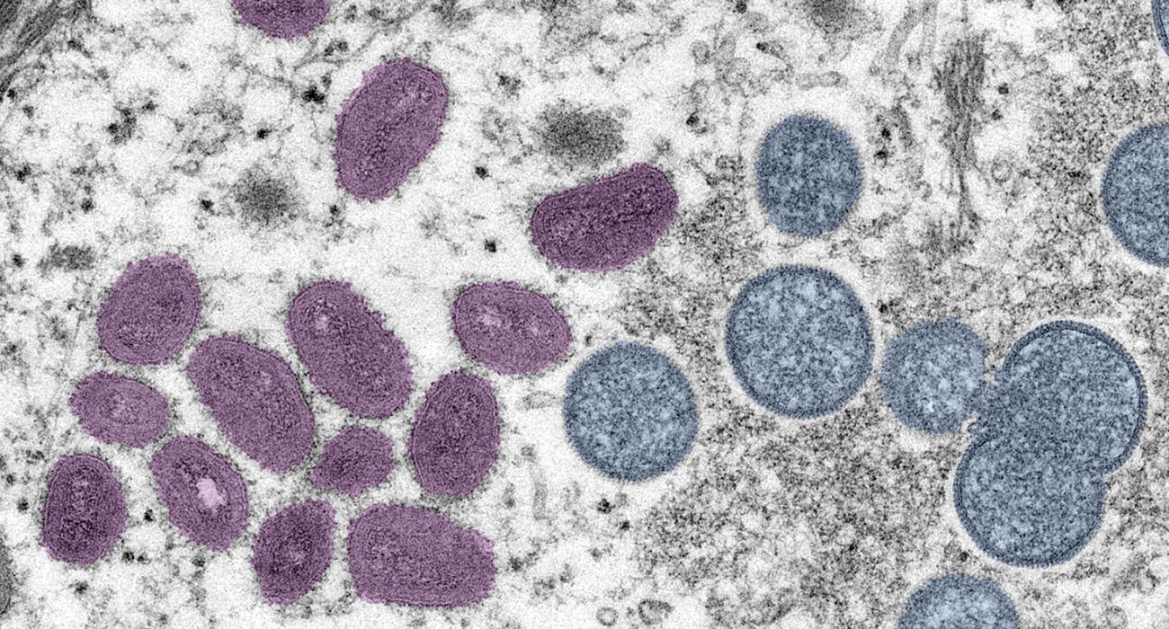 Texas Records First Death of Person with Monkeypox in U.S.