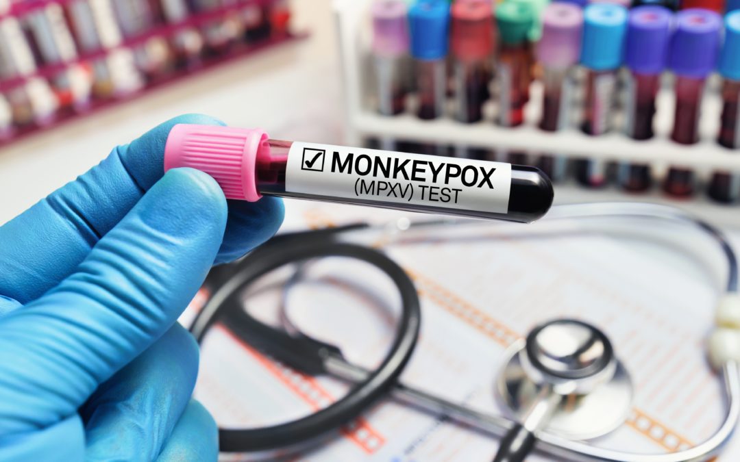 Local County Confirms 14 Monkeypox Cases 