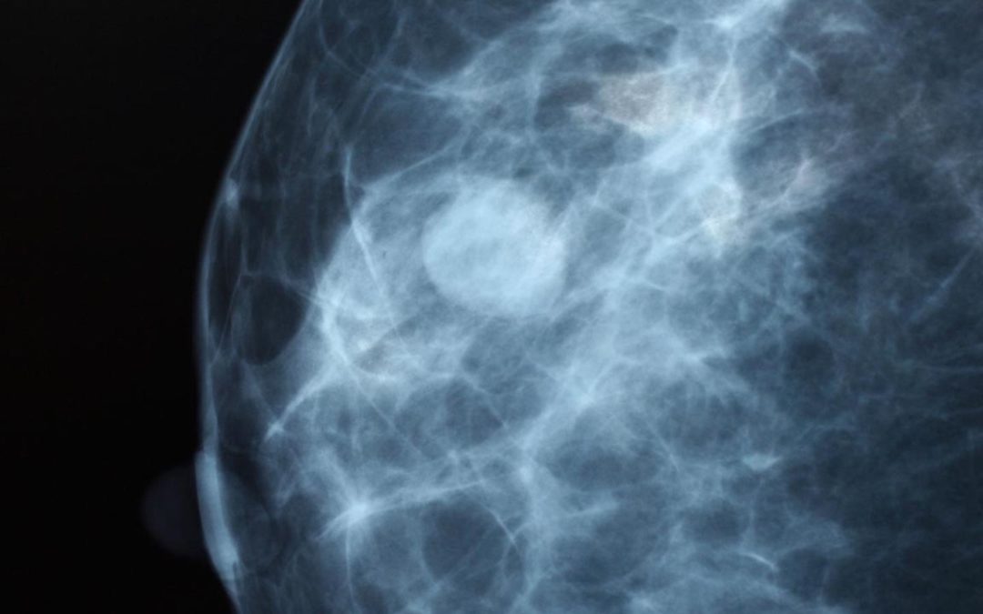 New Imaging May Be Future of Breast Cancer Treatment