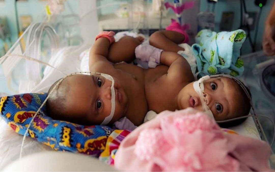 Conjoined TX Twins Separated in Rare Surgery