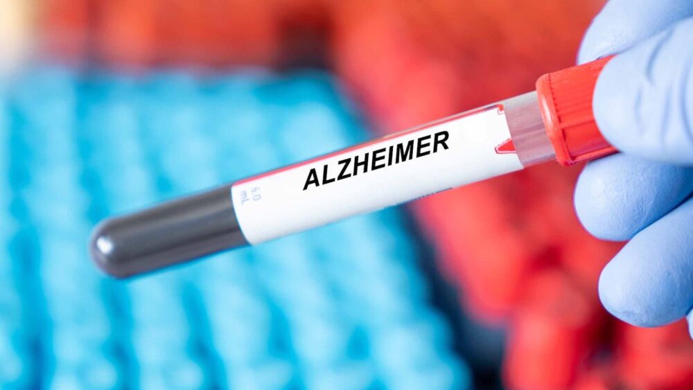 New Blood Test Identifies Alzheimer’s