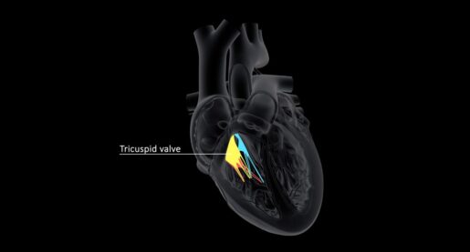 New Treatment Could Help Heart Valve Leaks