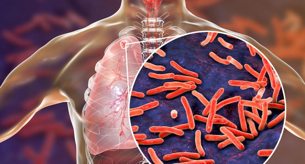 TB Cases Up by 5% Nationwide in 2022