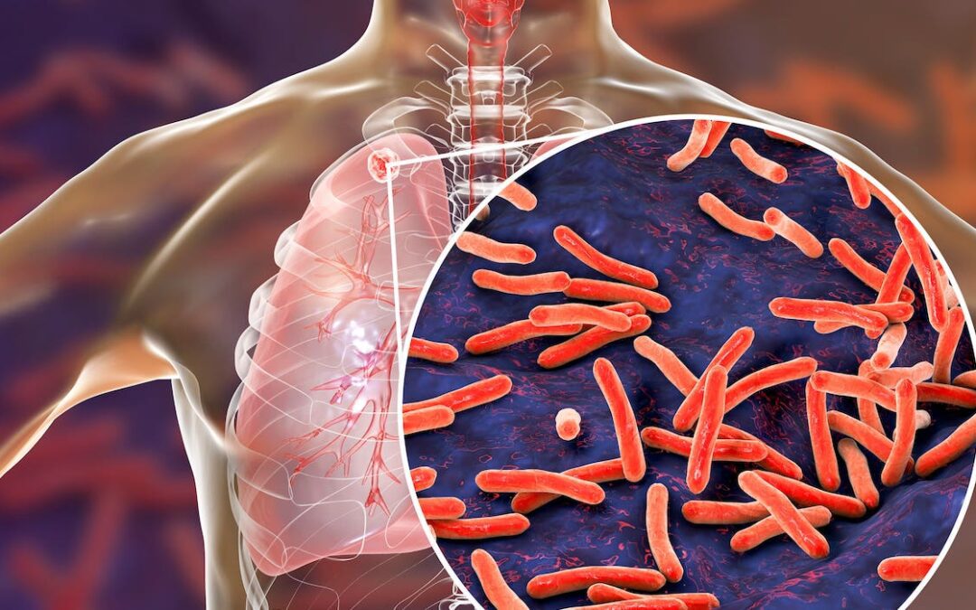 Los casos de tuberculosis aumentan un 5 % en todo el país en 2022