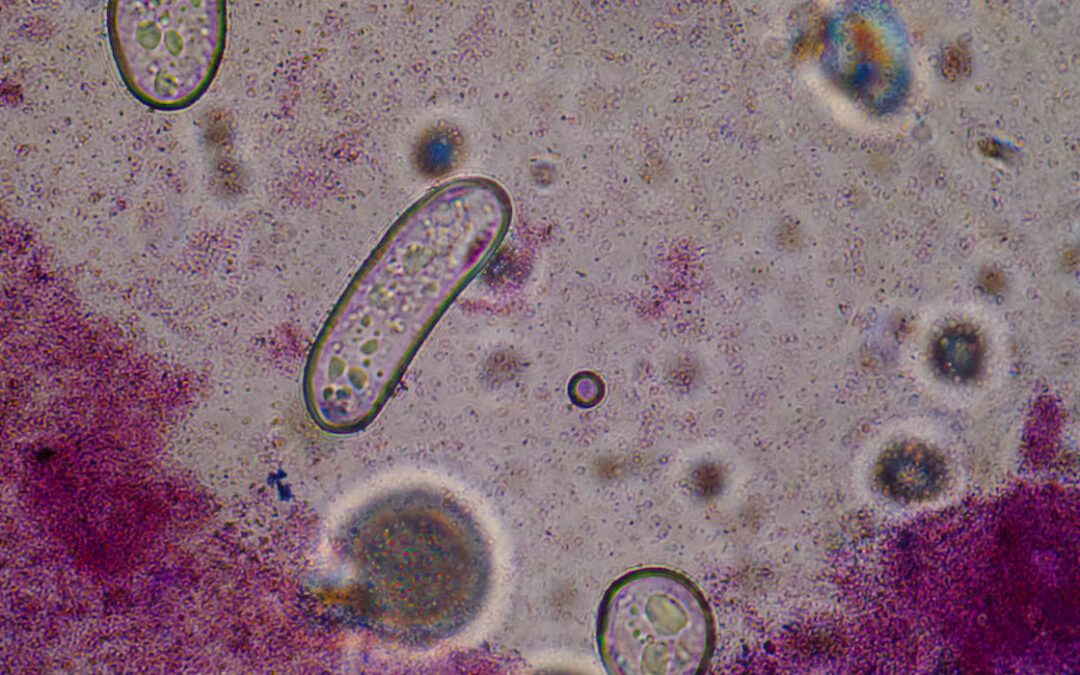 Family Fight Bite Spreads Flesh-Eating Bacteria