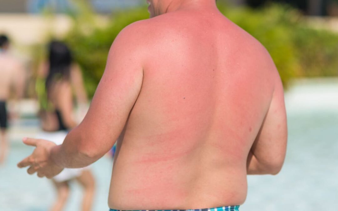 Consejos sobre cómo evitar quemarse con el sol