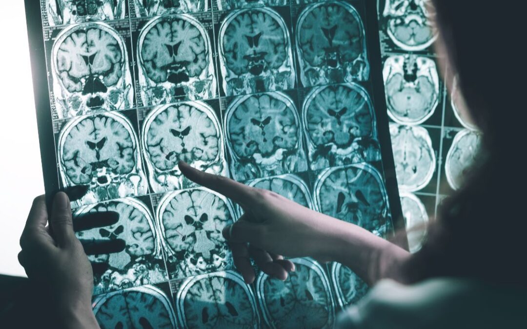 New Alzheimer’s Drug Works Best Early