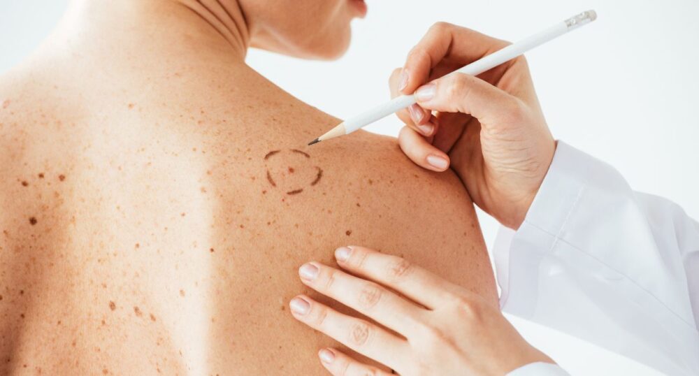 Non-Melanoma Cancer More Deadly Than Melanoma