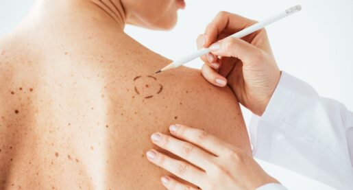 Non-Melanoma Cancer More Deadly Than Melanoma