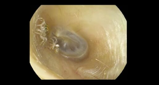 VIDEO: Living Spider Found in Woman’s Ear Canal