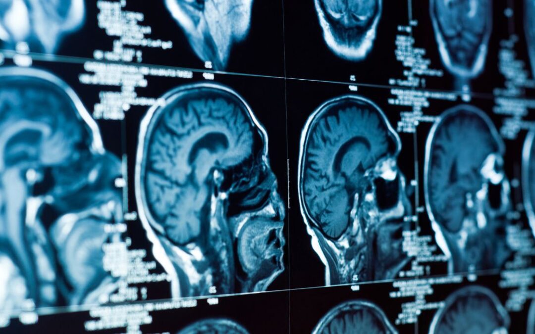 Los investigadores descubren qué hace que el cerebro humano sea especial