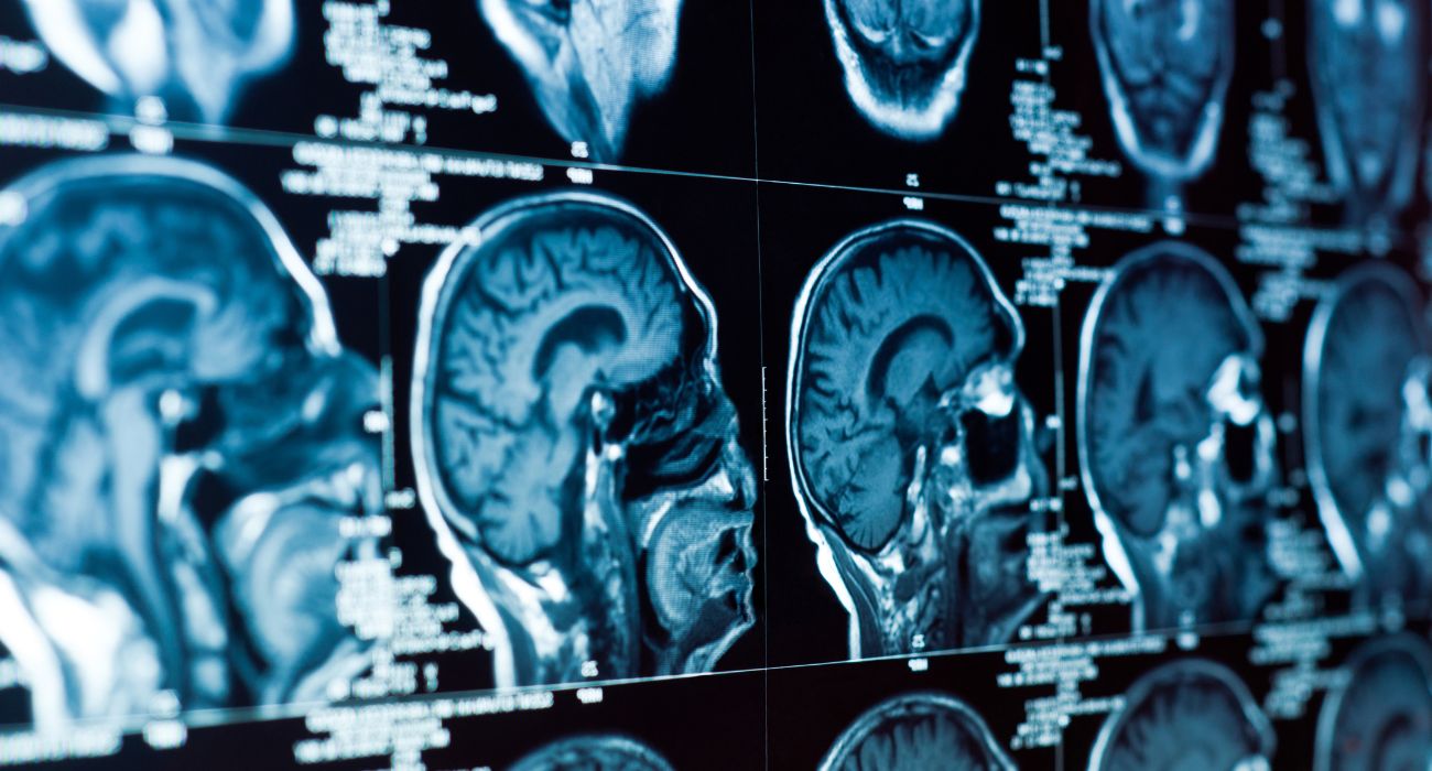 tomografía computarizada del cerebro