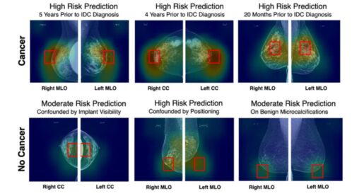 AI Model Predicts Future Breast Cancer Risks