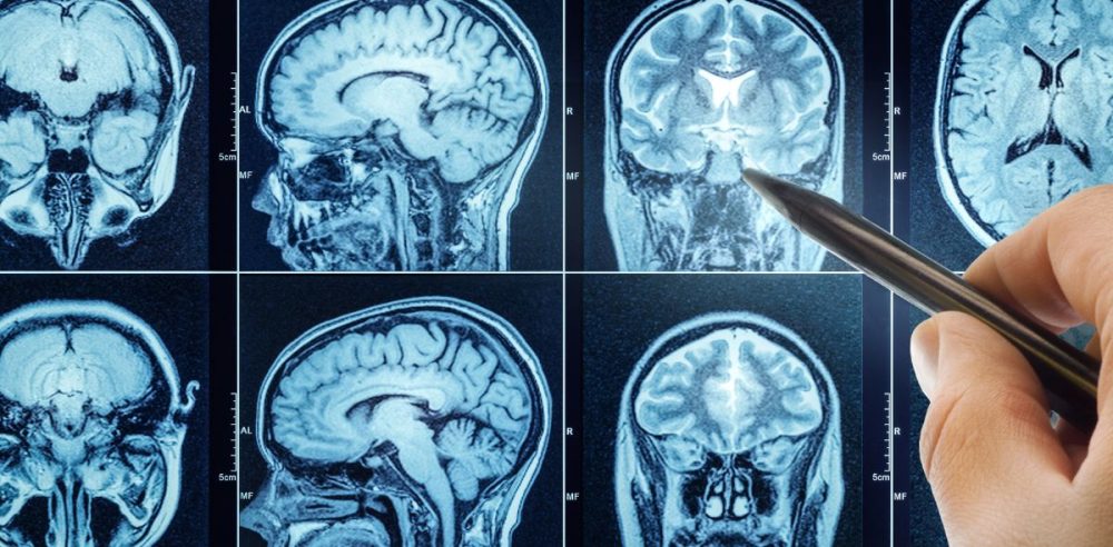 Brain Study Links Parkinson’s With ADHD