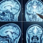 Brain Study Links Parkinson’s With ADHD