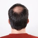 A New Ally In The Fight Against Hair Loss: Rogaine Meets Rosemary Oil