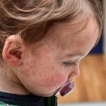 Texas Measles Outbreak Among Children Worsening