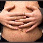 Maryland Confirms Measles Case; No Link To Texas Outbreak