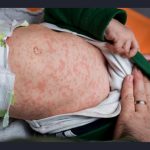 Texas Faces Measles Outbreak As Cases Rise; Public Health Officials Warn Of Continued Spread