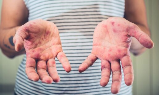 First Measles Case Recorded In Dallas County
