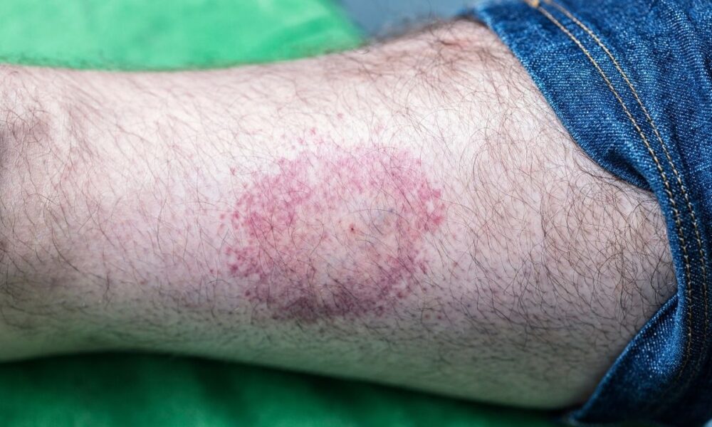 CDC Reports Near-Record Tick Bite ER Surge