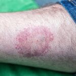 CDC Reports Near-Record Tick Bite ER Surge