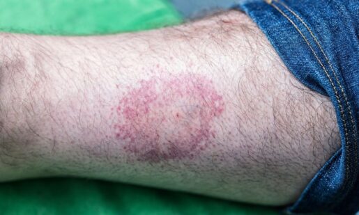 CDC Reports Near-Record Tick Bite ER Surge