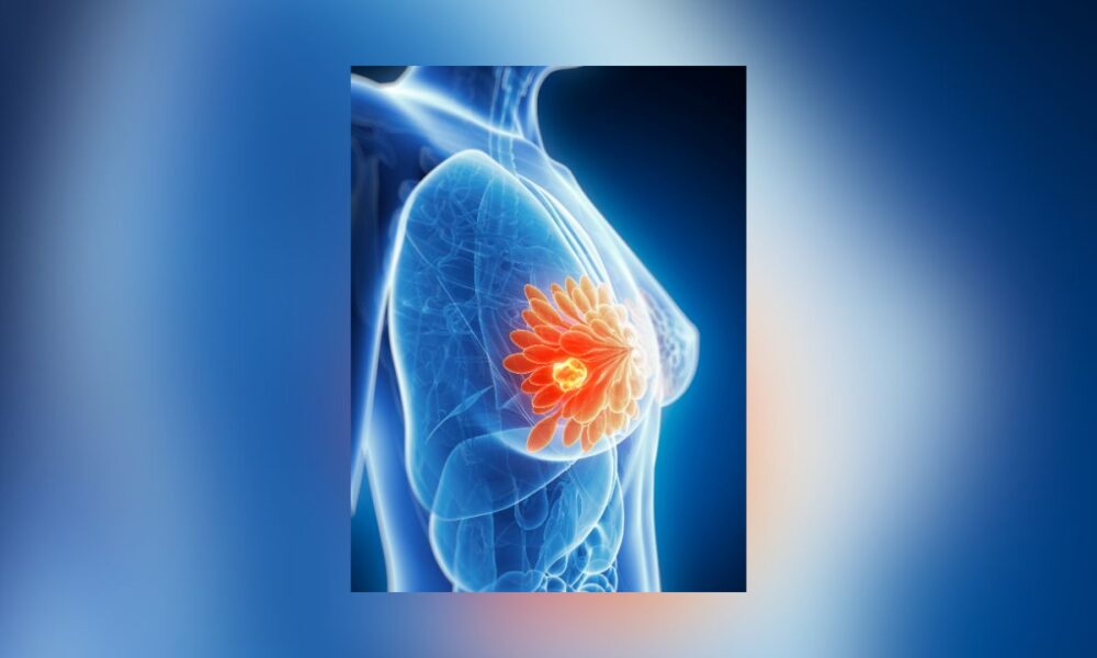 Study Reveals How Triple-Negative Breast Cancer Feeds On Nearby Fat Cells