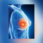 Study Reveals How Triple-Negative Breast Cancer Feeds On Nearby Fat Cells