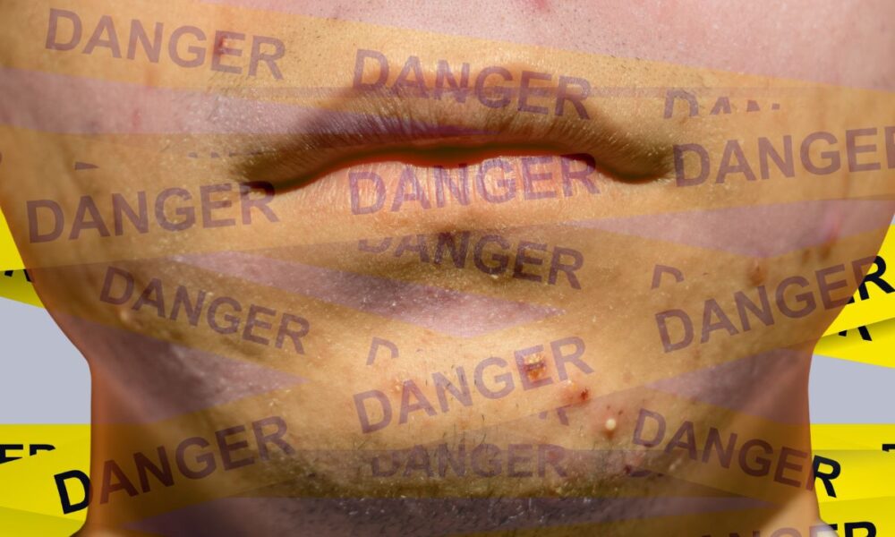 The Dark History Of Accutane: From Clear Skin To Criminal Courtrooms