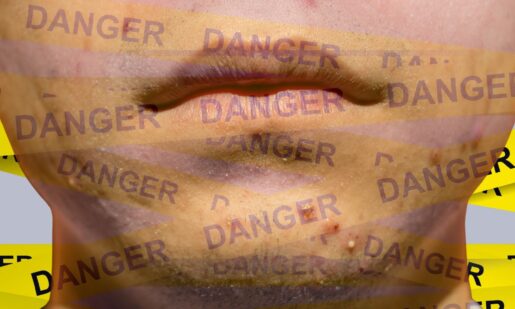 The Dark History Of Accutane: From Clear Skin To Criminal Courtrooms