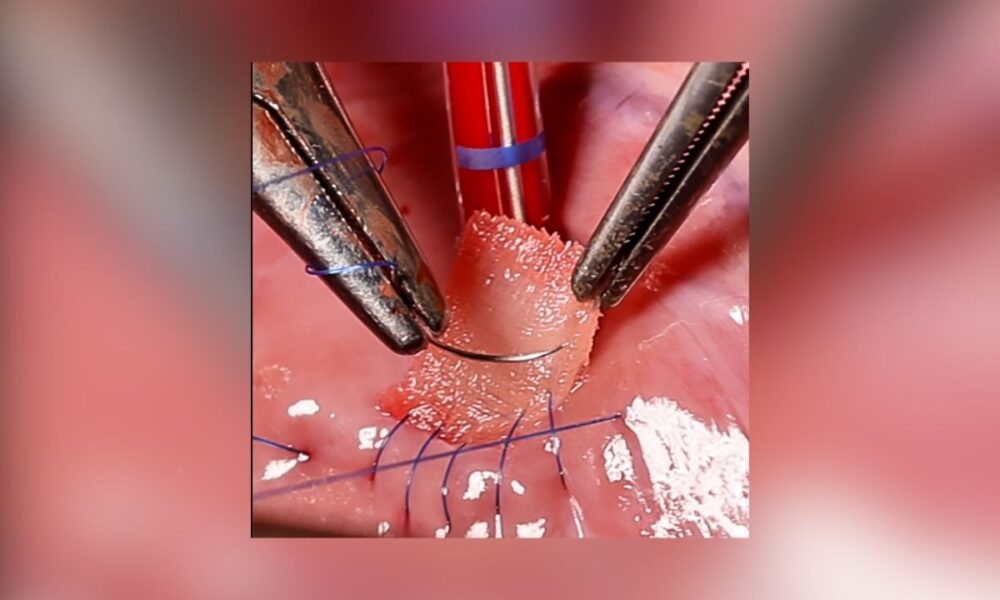 3D-Printed Heart Patch With Living Cells Offers Hope For Repairing Damaged Muscle