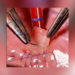 3D-Printed Heart Patch With Living Cells Offers Hope For Repairing Damaged Muscle