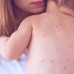 Analysis: More Deaths Linked To MMR Vaccination Than To Measles Since 1995